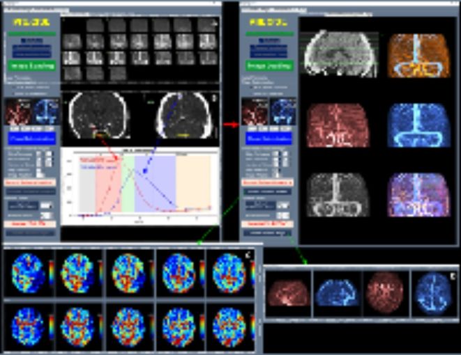 혈관재개통 환자 선별 S/W